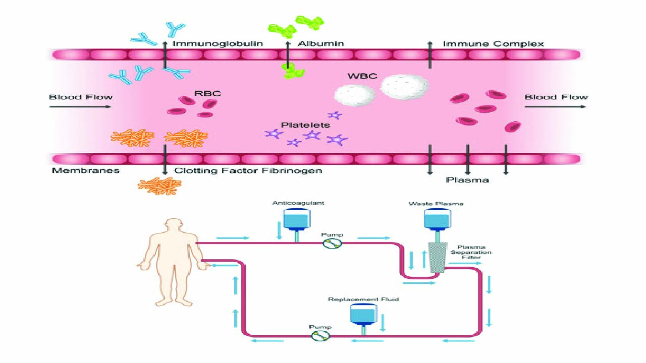 Fundamentals of Therapeutic Plasma Exchange (TPE)